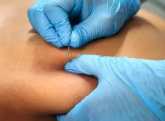 ims intramuscular stimulation