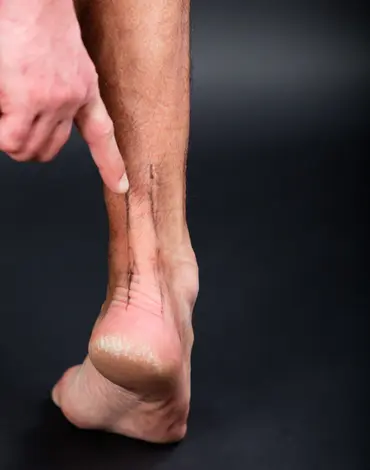 ligament and tendon tears