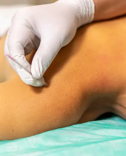 what is dry needling ims