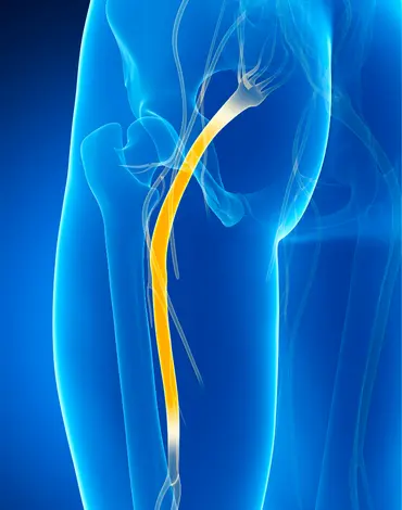 Sciatica and Nerve Pain